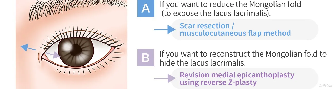 If you want to reduce a scar on the inner corner of the eye.